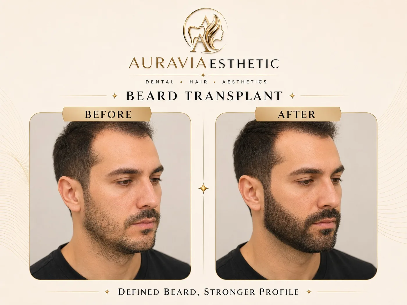 Beard transplant — jawline definition, before and after