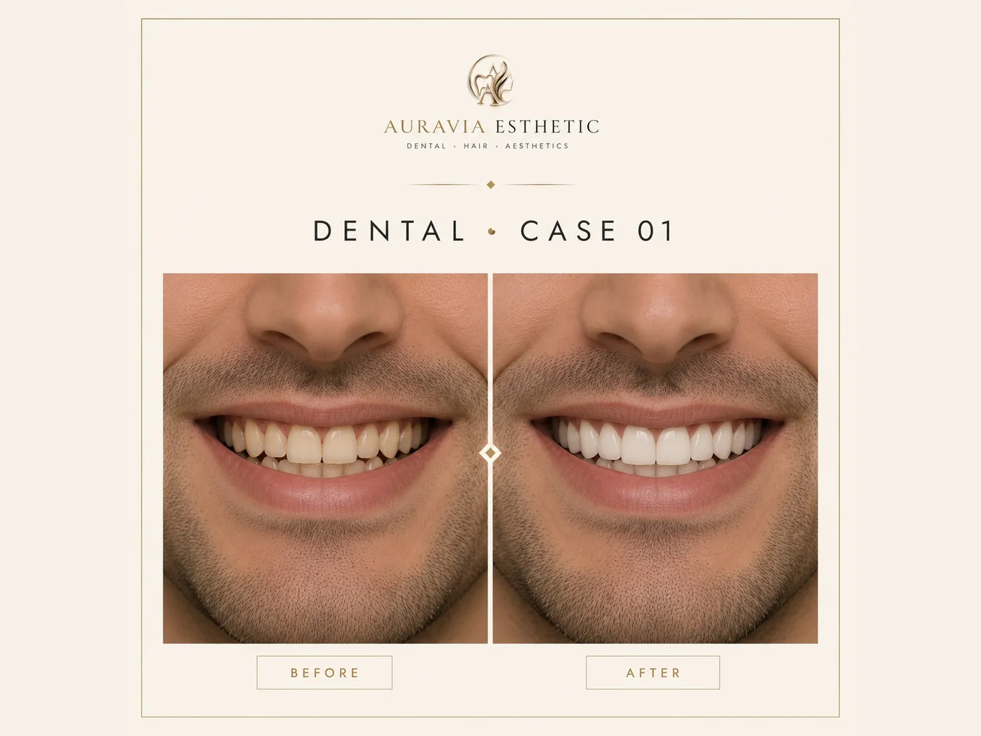 Dental aesthetics — case 01 · smile makeover, before and after