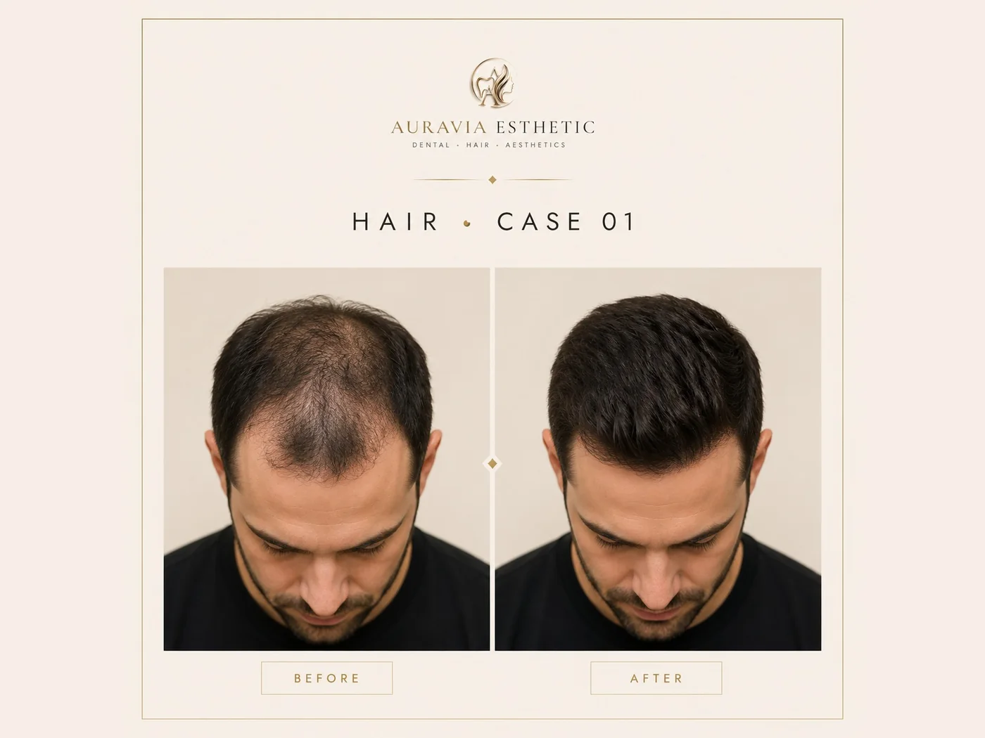 Hair transplant — case 01 · crown and mid-scalp, before and after