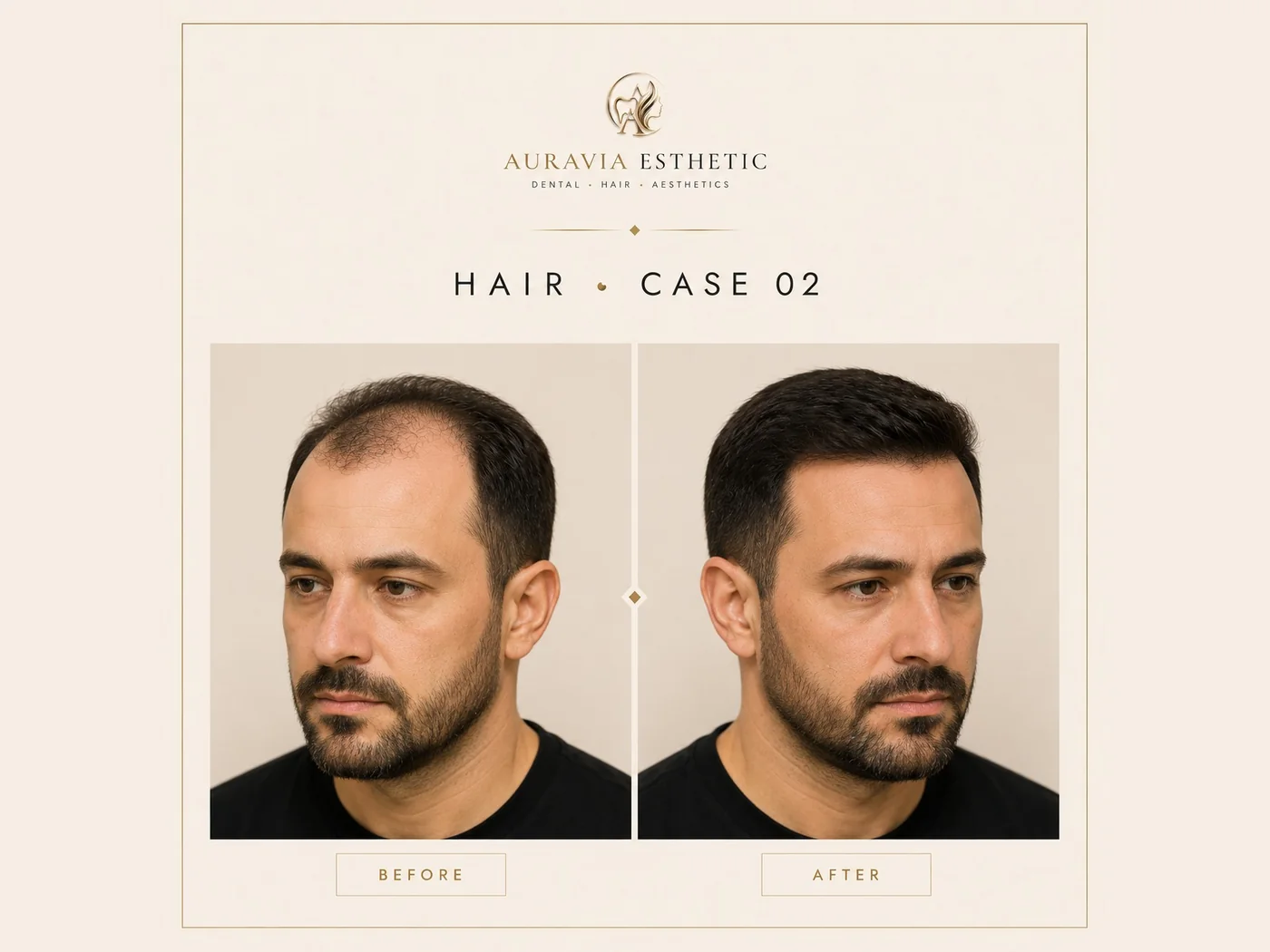 Hair transplant — case 02 · frontal restoration, before and after
